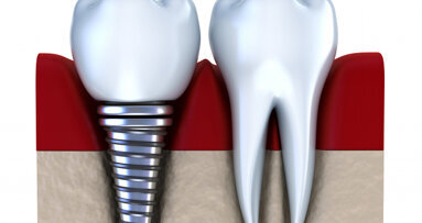 Zahnimplantate so sicher wie nie zuvor