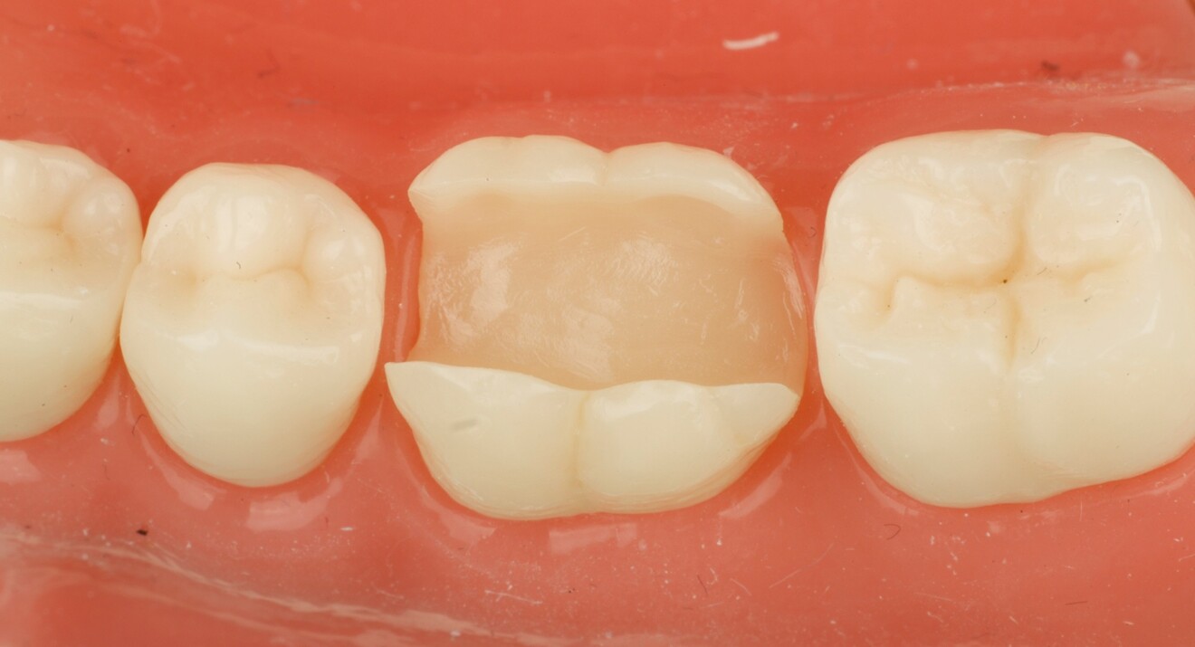 Fig. 2a: A CEREC Go workflow for a large Class II cavity involving cusp replacement. Pre-op situation before lingual cusp reduction and reinforcement with SDR Flow+. 