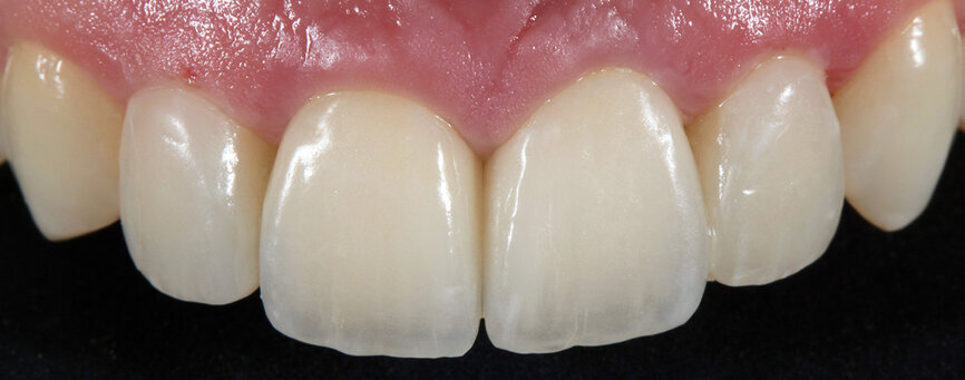 Fig. 14. Los dos tipos de restauración distintos presentan un juego de luces natural.