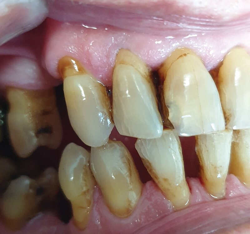 Sl. 2.2: Pacijent B, kontrola nakon mesec dana pušenja cigareta