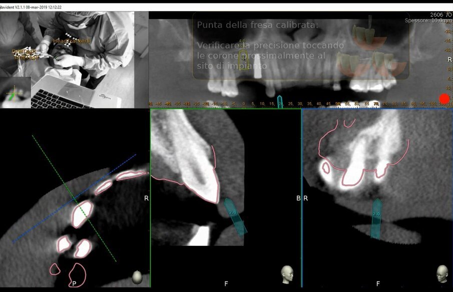 Figg. 13a-13c - Verifica di accuratezza. a) Verifica di accuratezza del Tracer dopo tastatura; b, c) Verifica di accuratezza della fresa prima della fresatura.