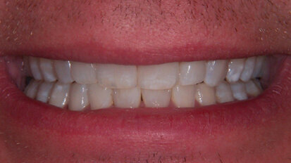 Principi biomimetici applicati all’odontoiatria cosmetica