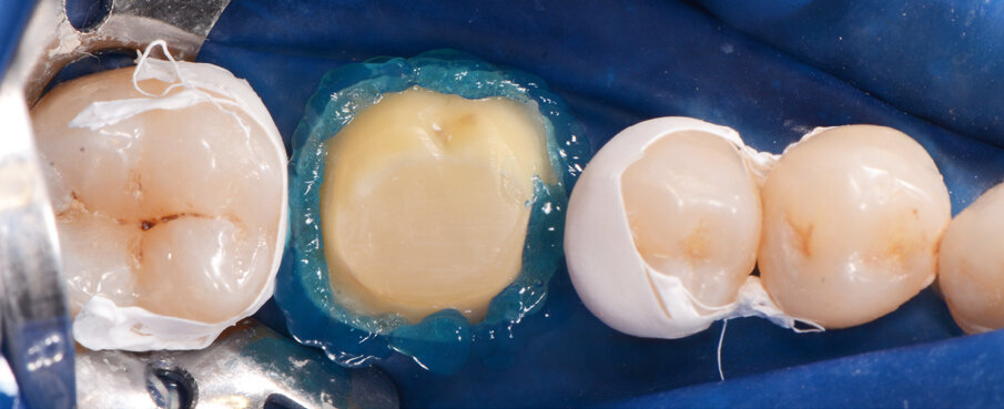 Fig. 6: Enamel etching prior to the application of the adhesive