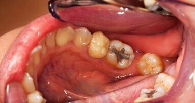 Primeira universidade brasileira a promover descarte ecológico de amálgama dentária