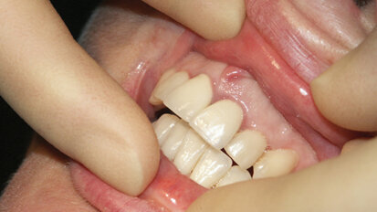 Dental implants can be successful with less root than crown
