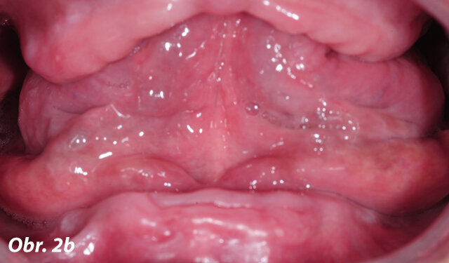 Intraorální pohled: resorbované alveolární výběžky a špatná klinická situace