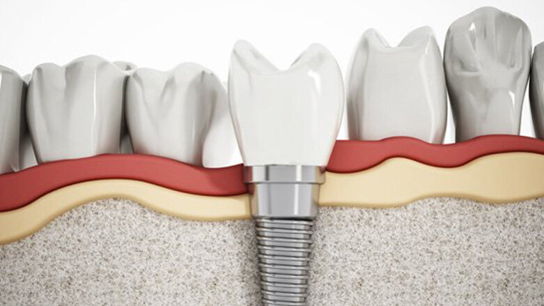 Immunreaktion bei Implantaten vermeiden