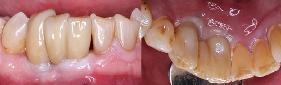 Figs. 16a & b: Completed prosthesis with a three-unit screw-retained bridge on the implants, labial (a) and palatal (b) view.