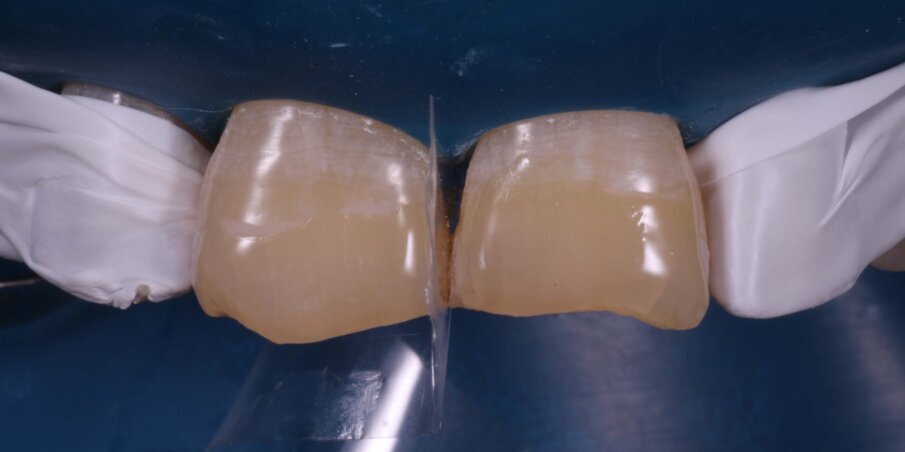 Fig 9. Application of bonding agent