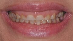 Comprehensive aesthetic transformation: Integrating hard- and soft-tissue treatments using the FotonaSMILE approach