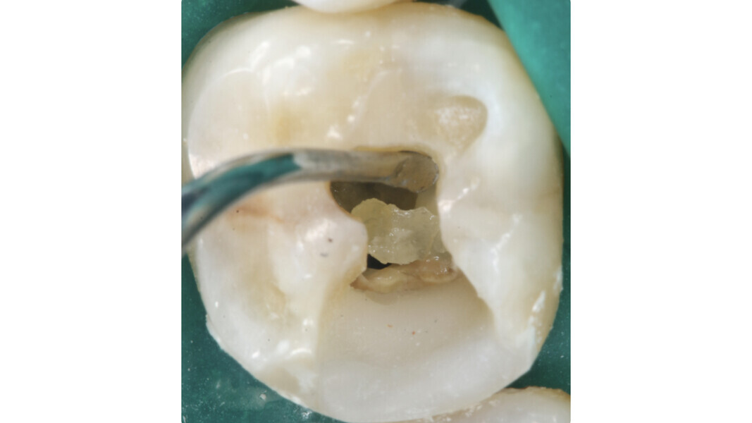 Fig. 17 : Élimination de la calcification au moyen d’un excavateur manuel.