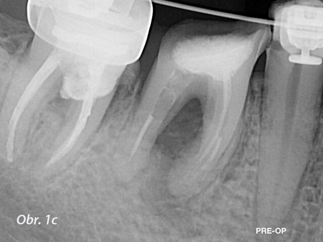 Řešení endodontických selhání