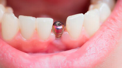 Un nuovo rivestimento potrebbe eliminare il rischio di insuccessi implantari