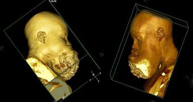 Head and neck surgeons remove rare facial tumor