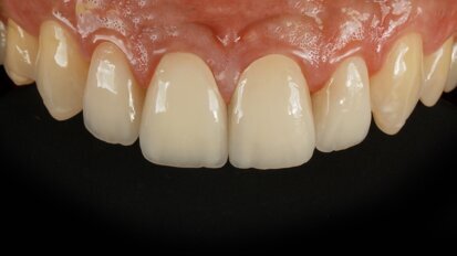 Free webinar puts pre-crystallised glass-ceramics in focus Free webinar puts pre-crystallised glass-ceramics in focus