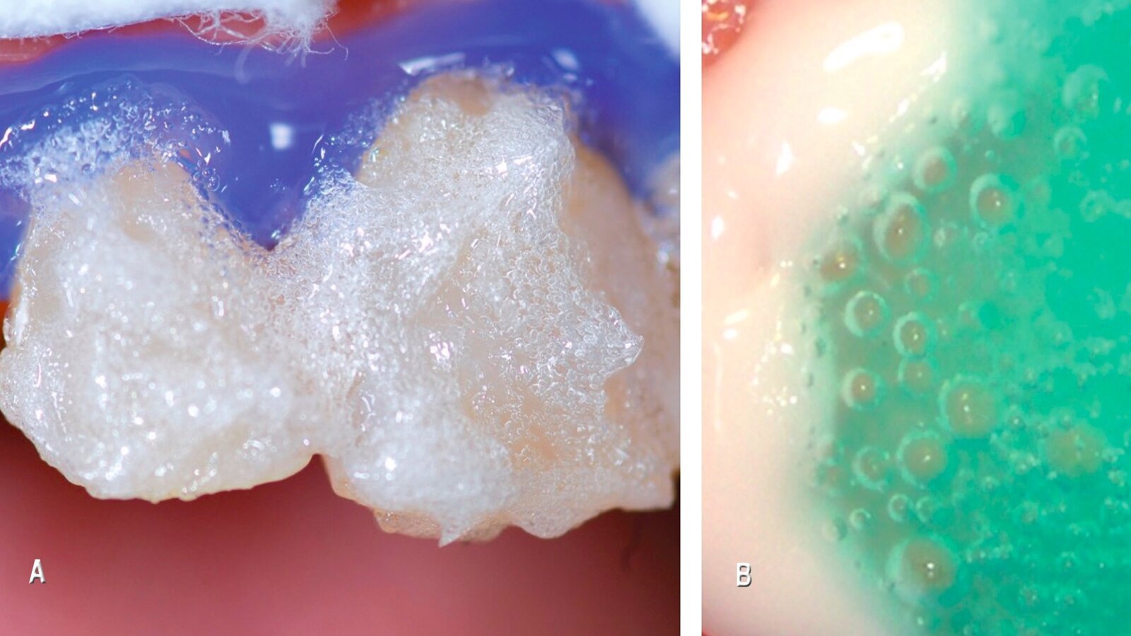 Estética y blanqueamiento dental en la era digital  (Capítulo 3)