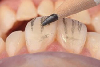 Sl. 15: Završna obrada i poliranje restauracije