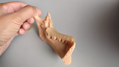 The advantages of digital planning and surgery-first for a better and predictable result in orthognathic surgery