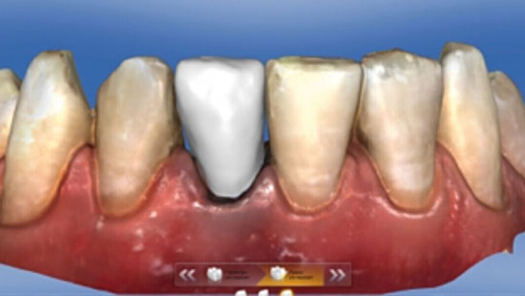 Fig. 8. La corona monolítica diseñada se confeccionó a partir de la cerámica vítrea reforzada con dióxido de circonio VITA SUPRINITY PC T 0M1.