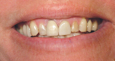 Estética en el sector anterior con un implante unitario