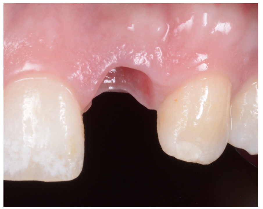 Fig. 11_Condizionamento del tunnel mucoso in un caso estetico.