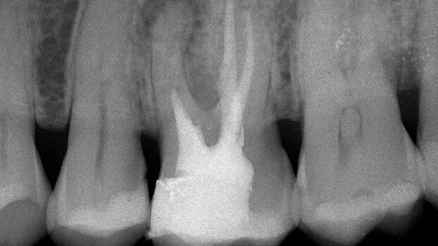 Micro-endodonzia chirurgica: lo stato dell’arte