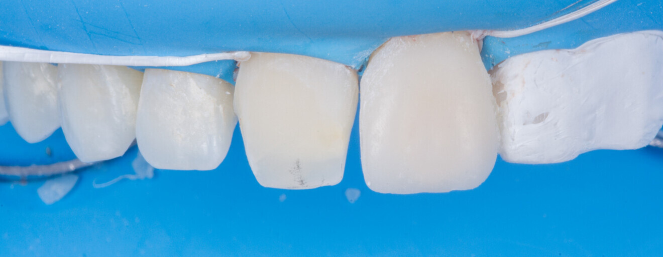 Fig. 14 : Résultat après élimination rapide des excès (lame 15 + lame 12 + strip diamantés + fraise flamme).