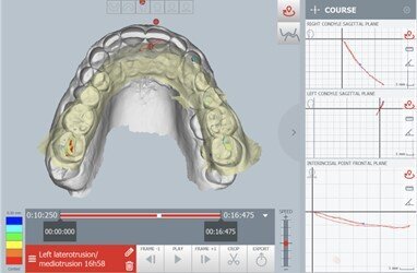 Fig. 6_Lateralità sinistra.