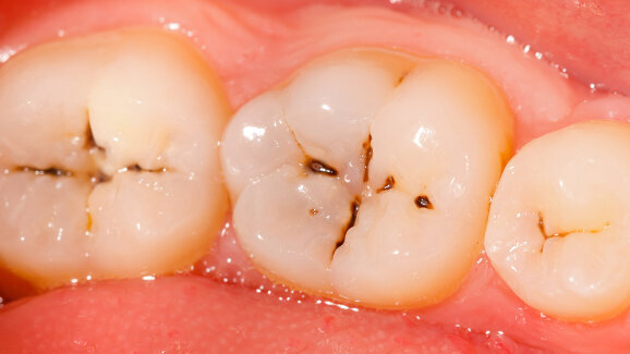 Cáries podem prevenir câncer bucal