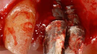 Rialzo di seno e rigenerazione ossea guidata per la riabilitazione implantare