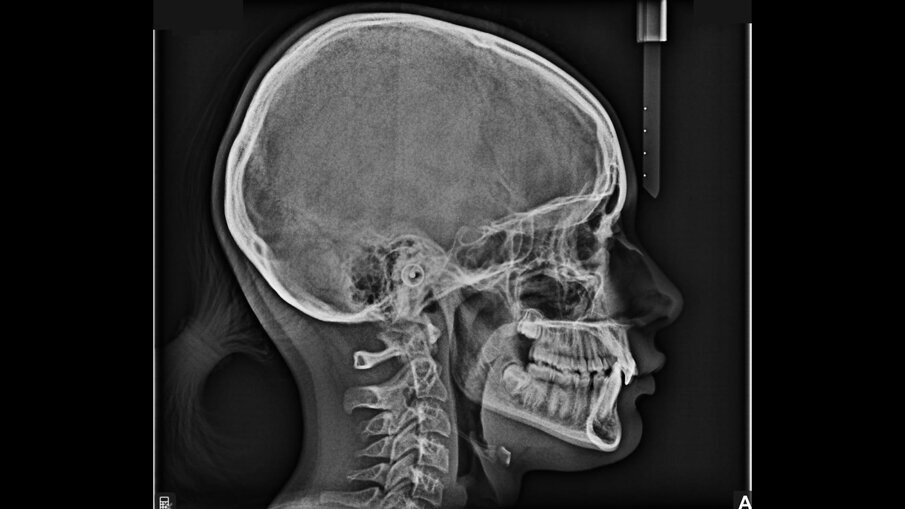 Fig. 10_Teleradiografia pre-trattamento.
