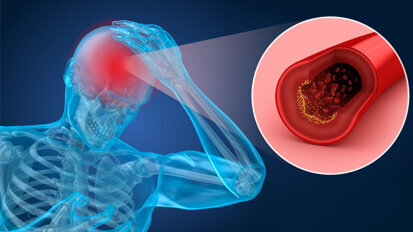 Warum gute Zahnpflege vor einem Schlaganfall schützen kann Warum gute Zahnpflege vor einem Schlaganfall schützen kann