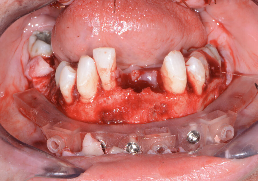 Fig. 12: Mandibular bone levelling foundation guide.