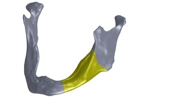 Немски учени развиват първия модифициран мандибуларен имплант