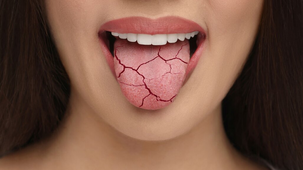 Kunstmatig speeksel uit hydrogelreservoir verlicht xerostomie