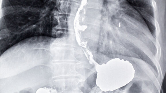 New breath test diagnoses oesophageal and gastric cancer
