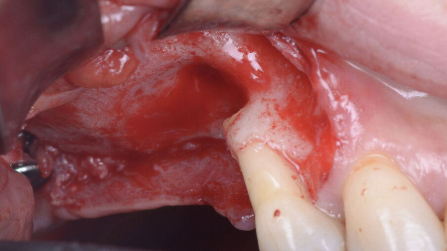 Fig. 3 - Scheletrizzazione del lembo, visione vestibolare.
