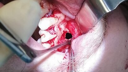 Hirurško uklanjanje retencione ciste (mukokele) iz maksilarnog sinusa u ambulantnim uslovima