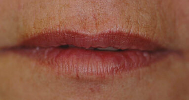 Take a cosmetic practice to the next level with facial injectables