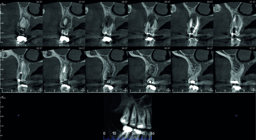 Fig. 5: Pre-op CBCT scan, sections.