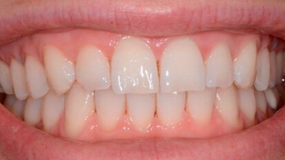 Approccio terapeutico combinato sbiancamento e Infiltrazione Icon della White Spot Lesions (WSL)