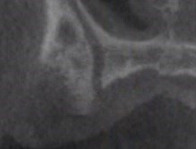 Fig. 4 - Immagine parassiale di CBCT raffigurante il forame accessorio del CS.