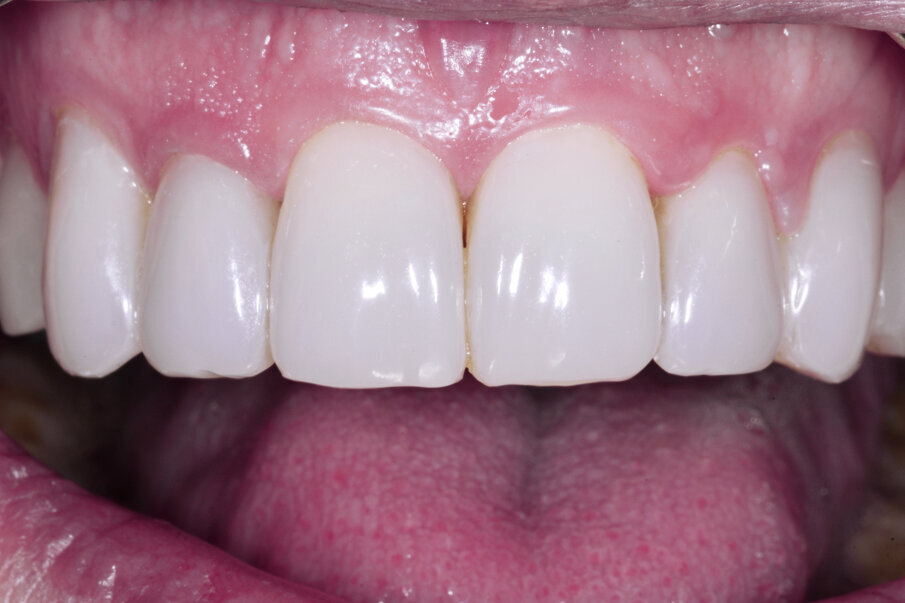 Fig. 21: Restoration of the same case with BRILLIANT COMPONEER