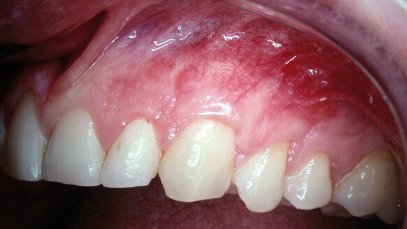 Using resorbable barriers to make root recession coverage predictable
