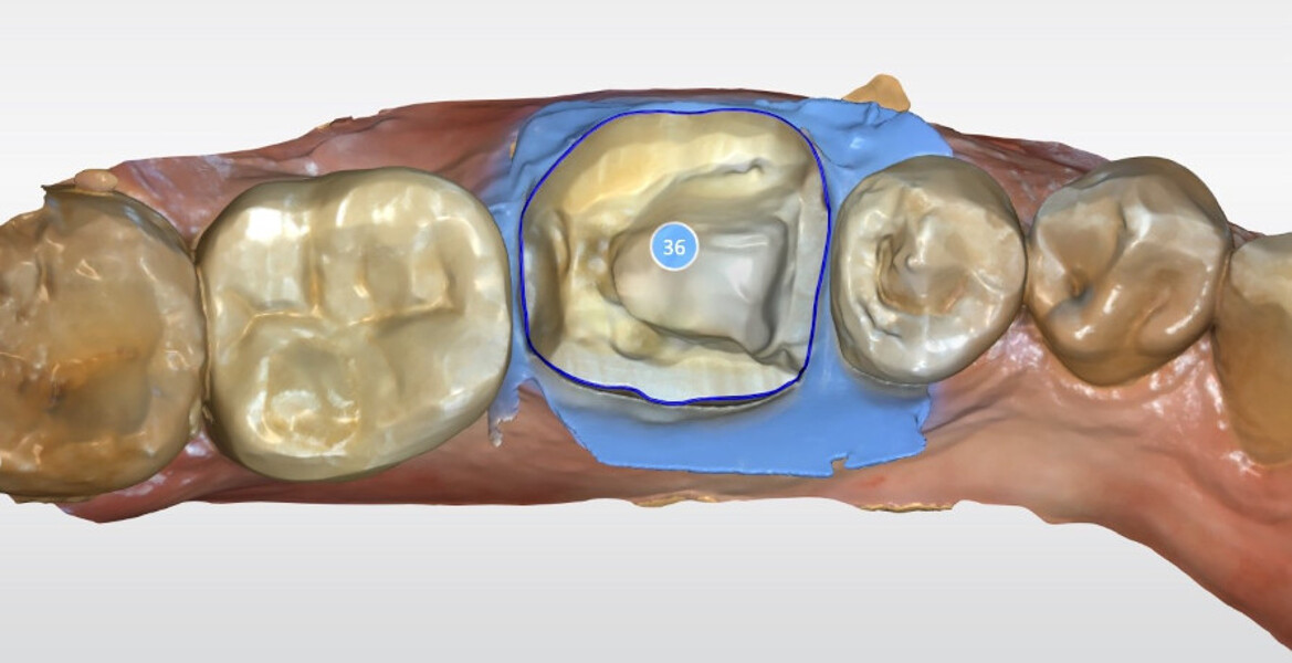 Fig. 19b: CAD workflow for tooth #36: definition of the preparation margin.