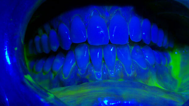 Il management di igiene orale e cosmesi in presenza di recessioni e abfrazioni: case report