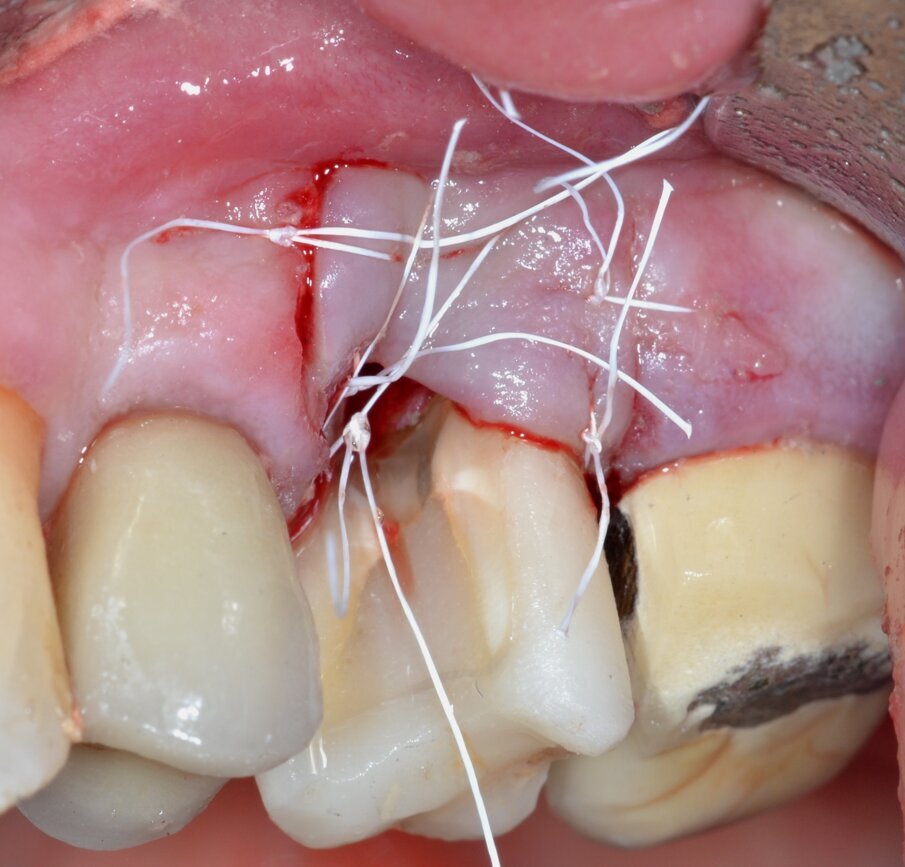 Fig. 8 - Lembo posizionato apicalmente alla cresta ossea e suturato con punti a materassaio ancorati al periostio e punti staccati.