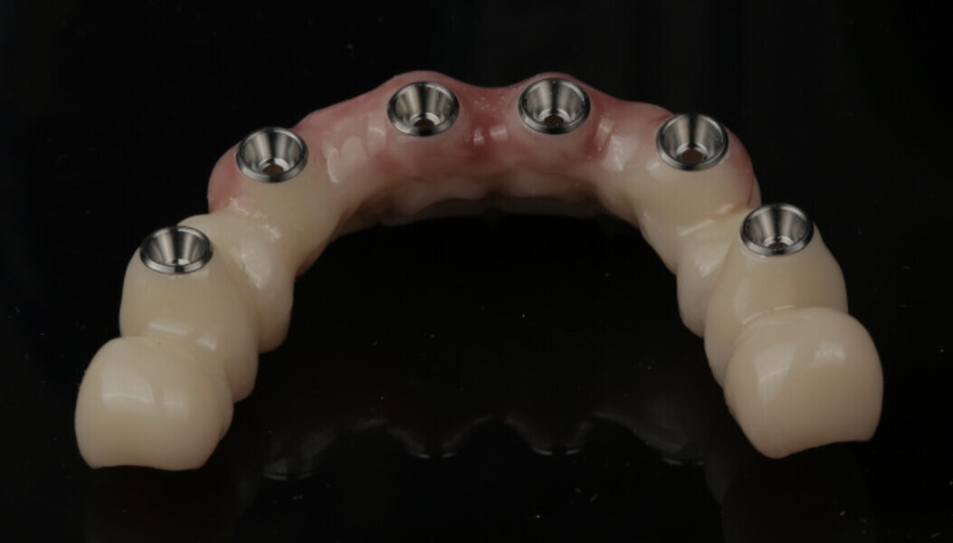Fig. 19b: FP-1 in the posterior.