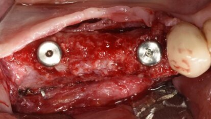 G.B.R di un grave difetto osseo orizzontale e verticale della mandibola con griglia in titanio