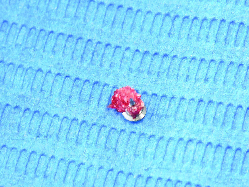 Fig. 19: Pin embedded in new bone.